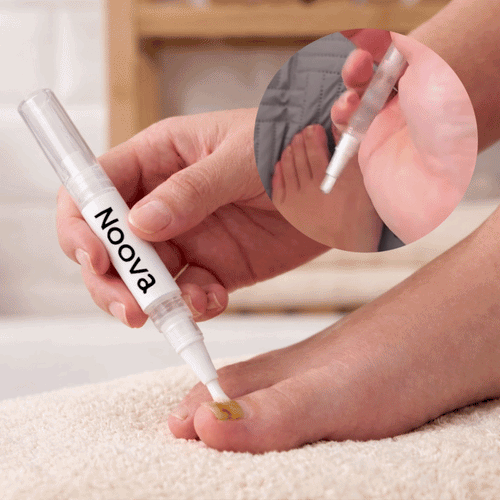 Antifungal Nail Pen (FREE Today)