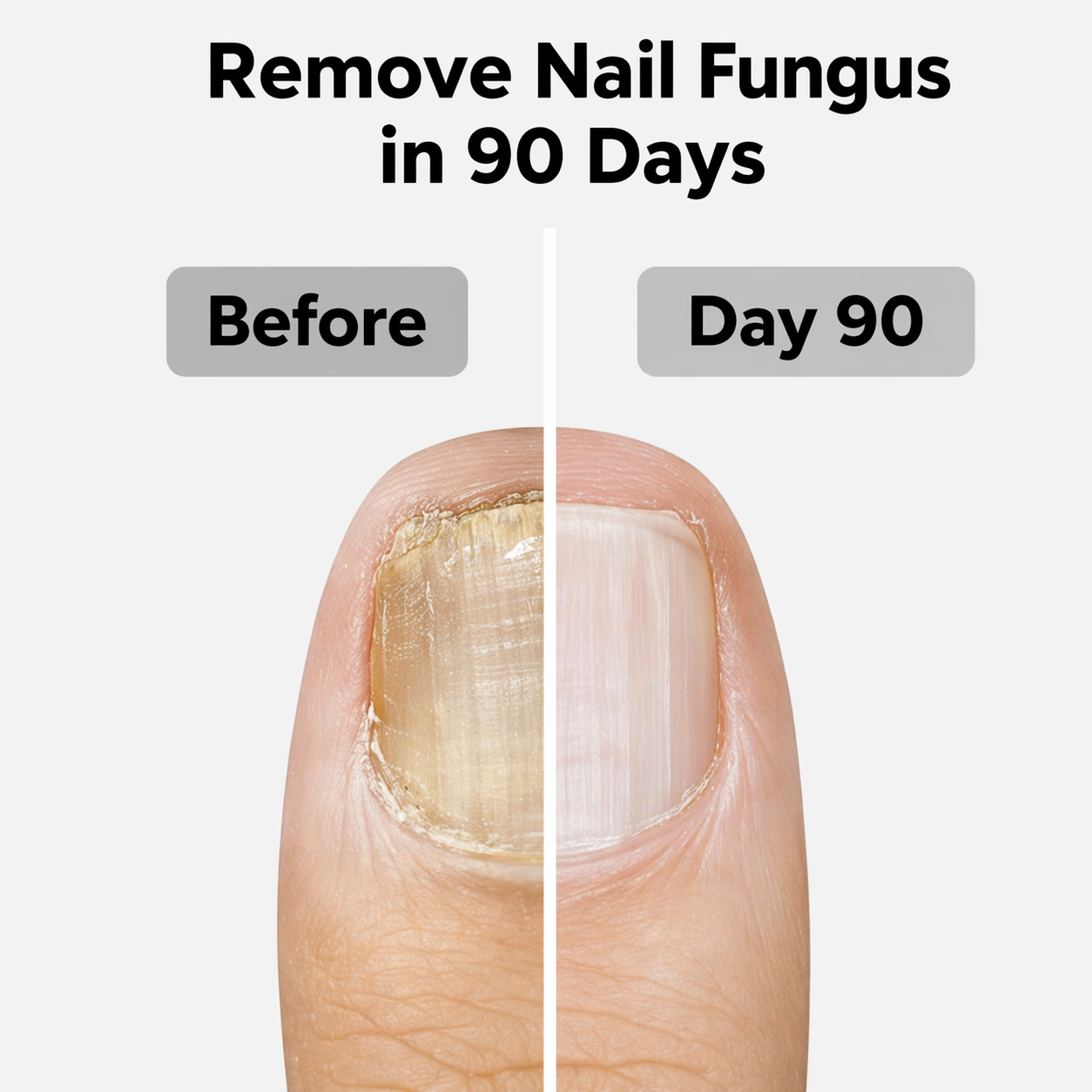Antifungal Nail Pen (FREE Today)
