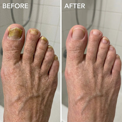 Antifungal Nail Pen (FREE Today)